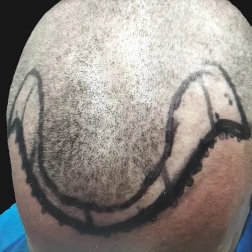 Before hair transplant