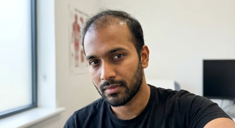 Arjun, 29, before FUE hair transplant